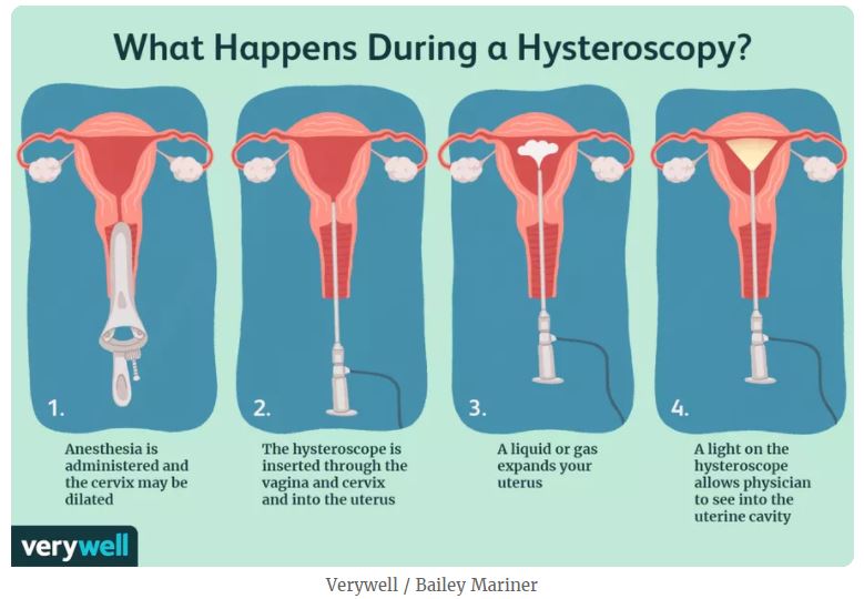 What is a Hysteroscopy?